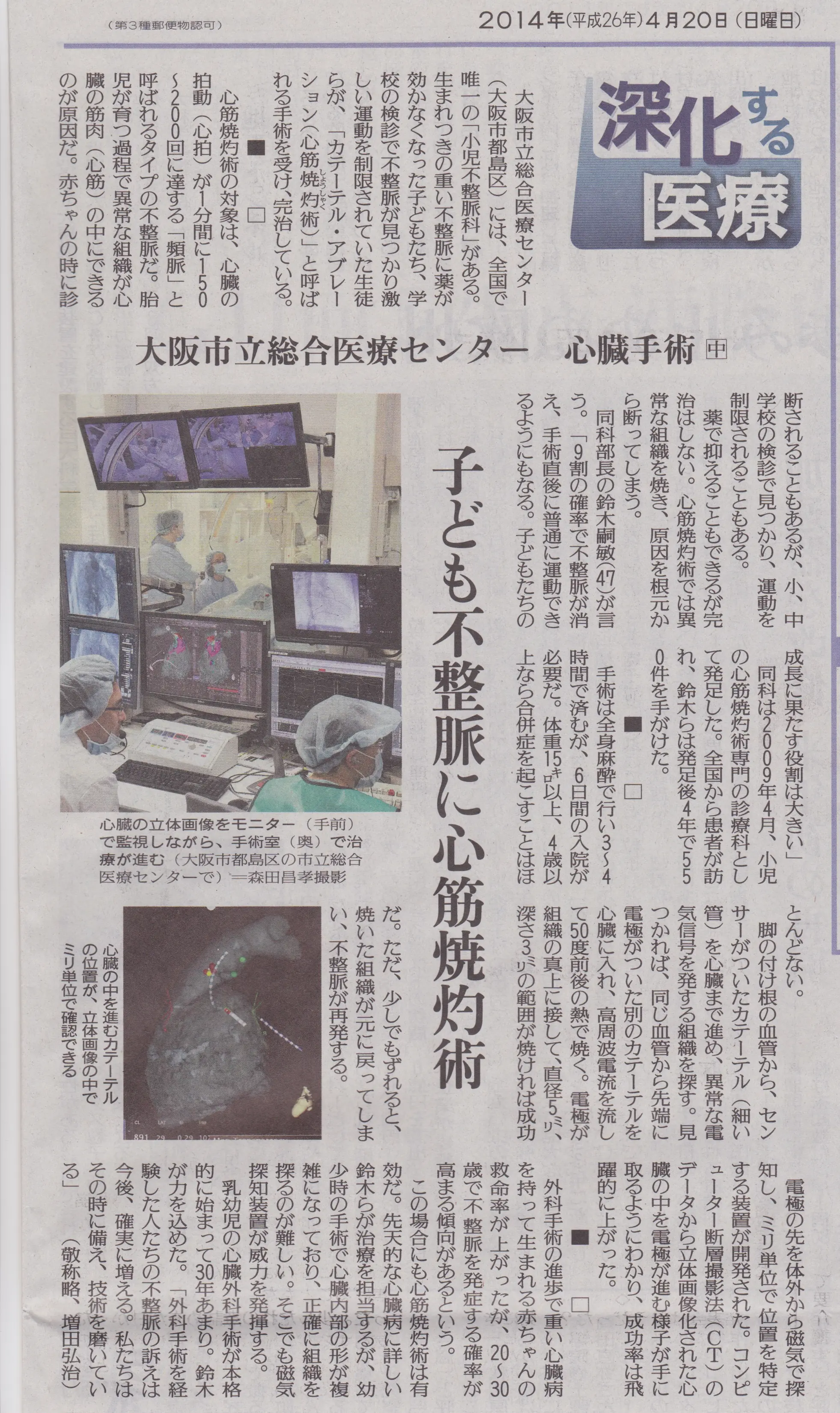 2014年4月20日 読売新聞「深化する医療」子ども不整脈に心筋焼灼術